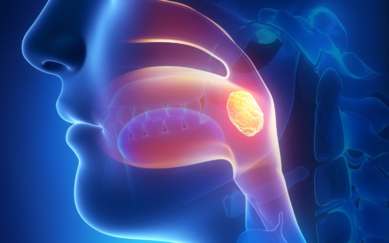 Tonsillectomia otorino Dott. Tabaro a Torino